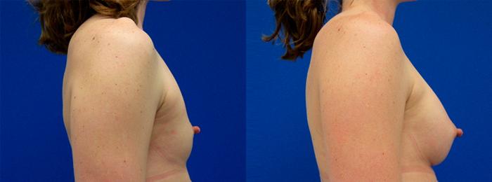 Hidden Breast Aug Before & After Gallery - Patient 153688 - Image 2