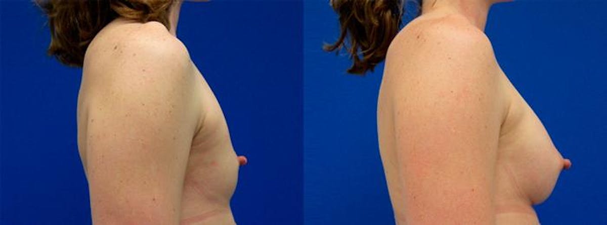 Breast Augmentation Before & After Gallery - Patient 122405438 - Image 2