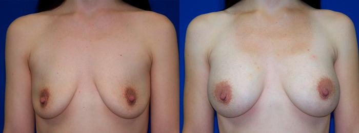 Hidden Breast Aug Before & After Gallery - Patient 266719 - Image 1
