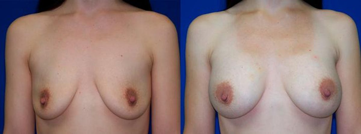 Breast Augmentation Before & After Gallery - Patient 957035 - Image 1