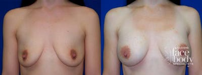 Hidden Breast Aug Before & After Gallery - Patient 266719 - Image 1
