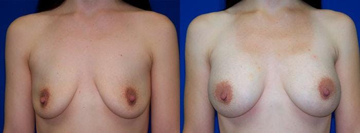 Breast Augmentation Before & After Gallery - Patient 122405440 - Image 1