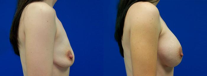 Hidden Breast Aug Before & After Gallery - Patient 266719 - Image 2
