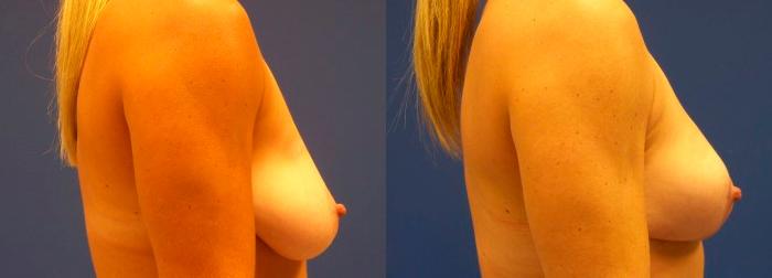 Hidden Breast Lift Before & After Gallery - Patient 907831 - Image 2