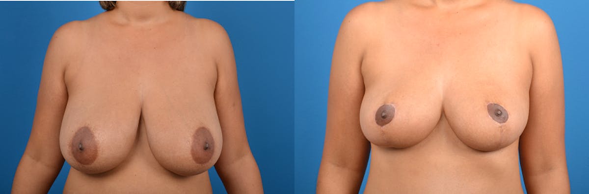 Breast Reduction Before & After Gallery - Patient 351368 - Image 1