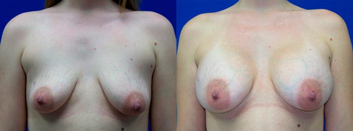 Hidden Breast Aug Before & After Gallery - Patient 127373 - Image 1