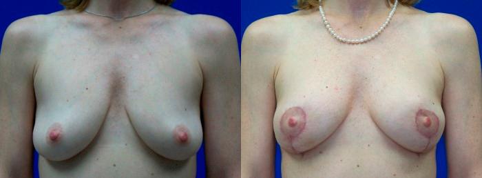 Hidden Breast Lift Before & After Gallery - Patient 120551 - Image 1