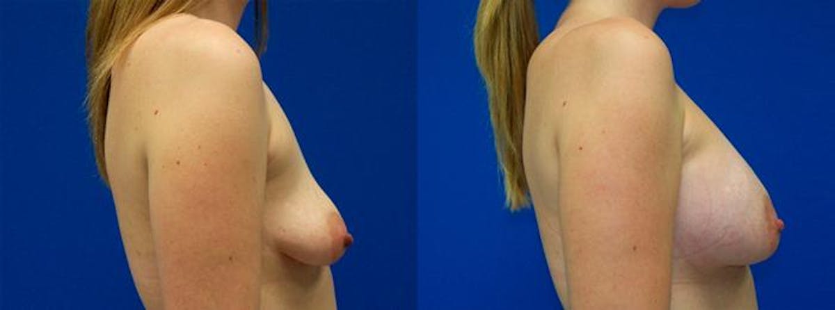 Breast Augmentation Before & After Gallery - Patient 244976 - Image 2