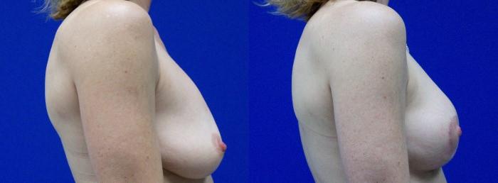 Hidden Breast Lift Before & After Gallery - Patient 120551 - Image 2