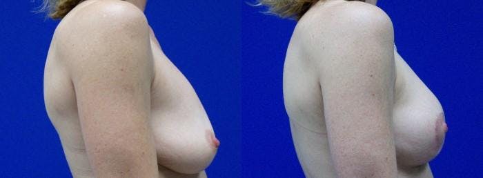 Breast Lift Before & After Gallery - Patient 122405443 - Image 2