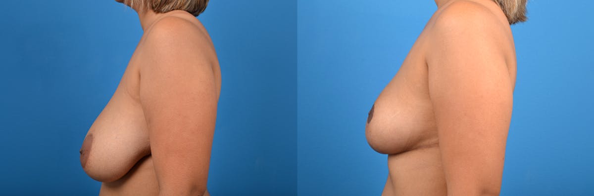 Hidden Breast Reduction Before & After Gallery - Patient 284071 - Image 2