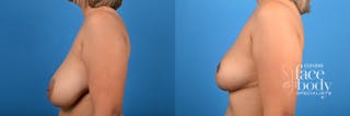 Hidden Breast Reduction Before & After Gallery - Patient 284071 - Image 2