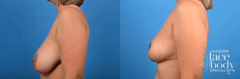 Hidden Breast Reduction Before & After Gallery - Patient 284071 - Image 2