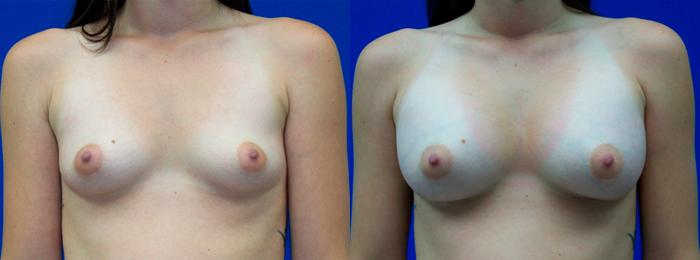 Hidden Breast Aug Before & After Gallery - Patient 877263 - Image 1