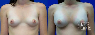 Hidden Breast Aug Before & After Gallery - Patient 297801 - Image 1