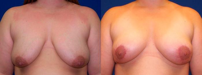 Hidden Breast Lift Before & After Gallery - Patient 159589 - Image 1