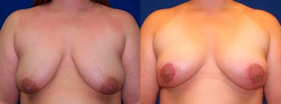 Hidden Breast Lift Before & After Gallery - Patient 159589 - Image 1