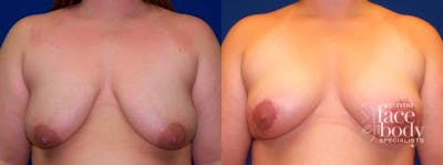 Hidden Breast Lift Before & After Gallery - Patient 159589 - Image 1