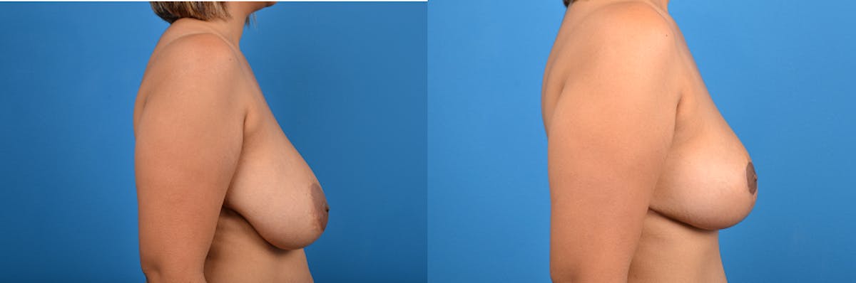 Hidden Breast Reduction Before & After Gallery - Patient 284071 - Image 3