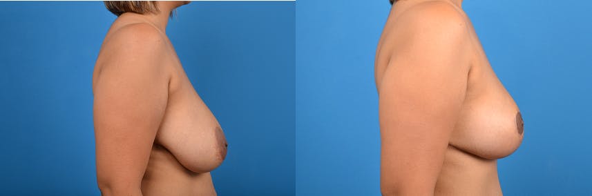 Breast Reduction Before & After Gallery - Patient 122405445 - Image 3