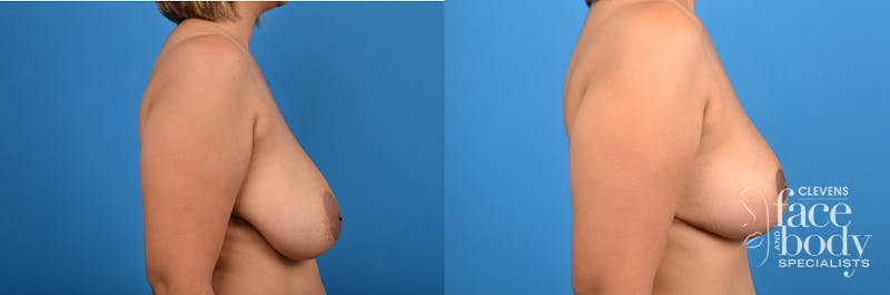 Hidden Breast Reduction Before & After Gallery - Patient 284071 - Image 3