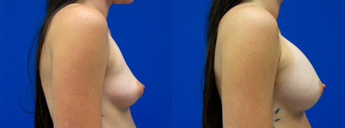 Hidden Breast Aug Before & After Gallery - Patient 877263 - Image 2