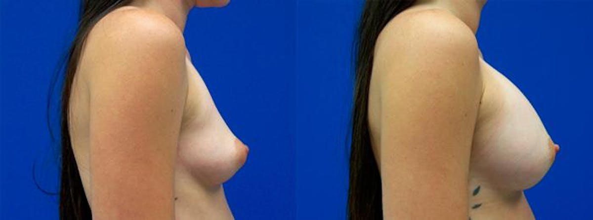 Breast Augmentation Before & After Gallery - Patient 388684 - Image 2
