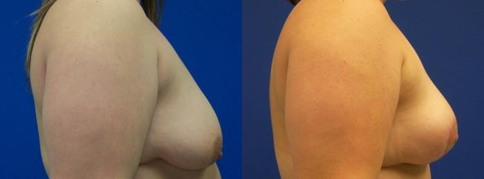 Hidden Breast Lift Before & After Gallery - Patient 159589 - Image 2