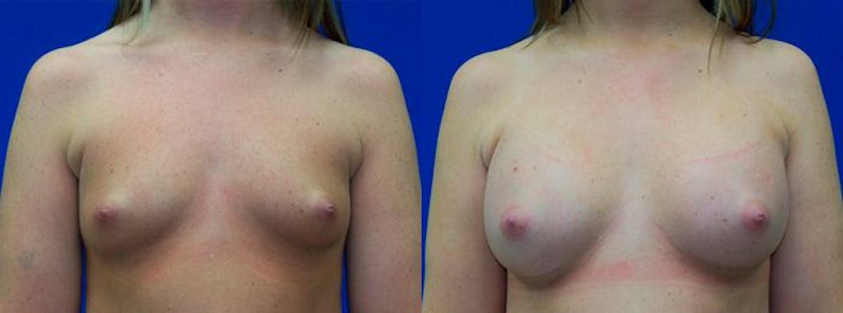 Breast Augmentation Before & After Gallery - Patient 122405447 - Image 1