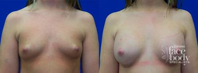 Hidden Breast Aug Before & After Gallery - Patient 147807 - Image 1