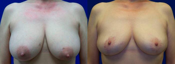 Hidden Breast Reduction Before & After Gallery - Patient 131512 - Image 1