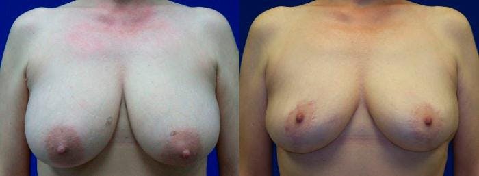 Breast Reduction Before & After Gallery - Patient 122405448 - Image 1
