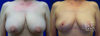 Hidden Breast Reduction Before & After Gallery - Patient 131512 - Image 1