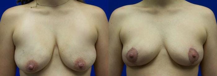 Breast Lift Before & After Gallery - Patient 122405450 - Image 1