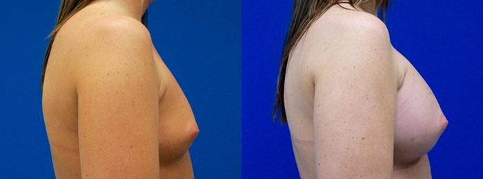 Breast Augmentation Before & After Gallery - Patient 122405447 - Image 2
