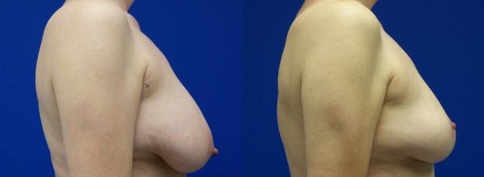Hidden Breast Reduction Before & After Gallery - Patient 131512 - Image 2