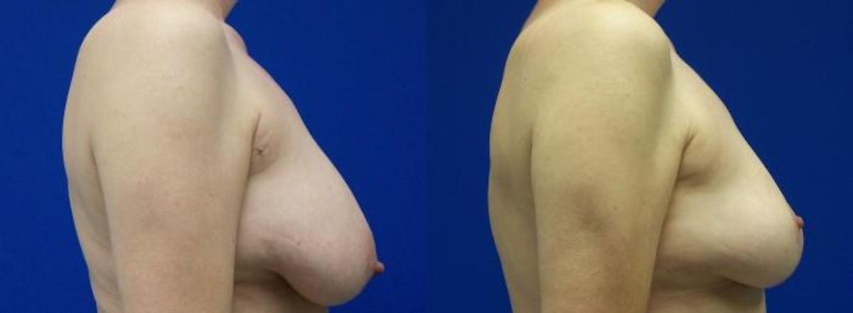 Breast Reduction Before & After Gallery - Patient 398034 - Image 2