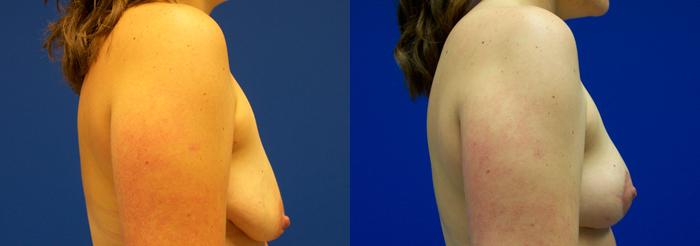 Hidden Breast Lift Before & After Gallery - Patient 292801 - Image 2
