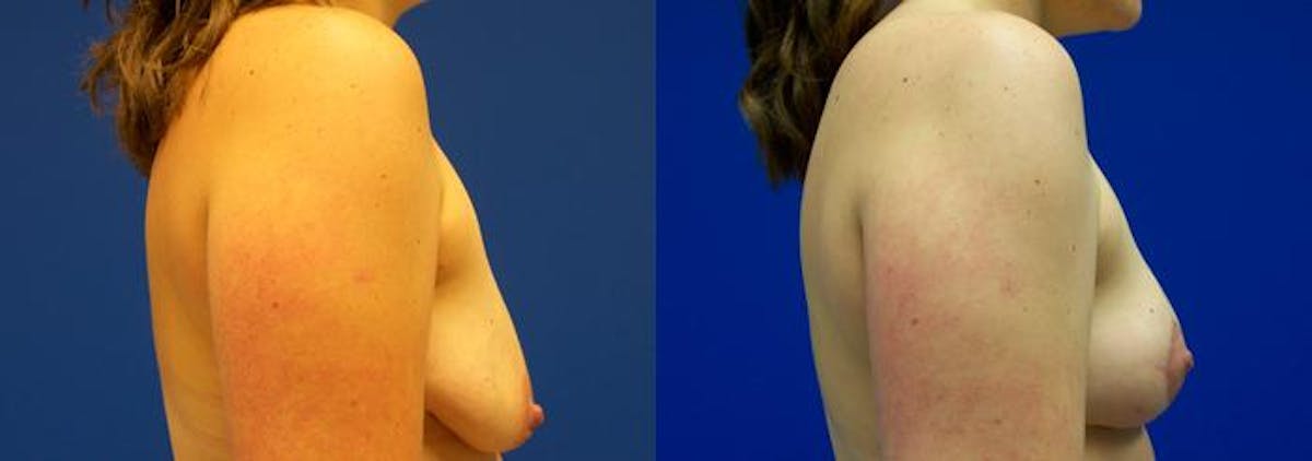 Breast Lift Before & After Gallery - Patient 146923 - Image 2