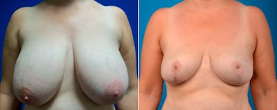 Hidden Breast Reduction Before & After Gallery - Patient 158033 - Image 1