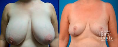 Hidden Breast Reduction Before & After Gallery - Patient 158033 - Image 1