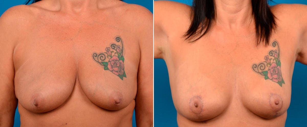 Breast Lift Before & After Gallery - Patient 317297 - Image 1