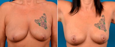 Breast Lift Before & After Gallery - Patient 317297 - Image 1