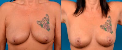 Hidden Breast Lift Before & After Gallery - Patient 418575 - Image 1