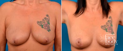 Hidden Breast Lift Before & After Gallery - Patient 418575 - Image 1