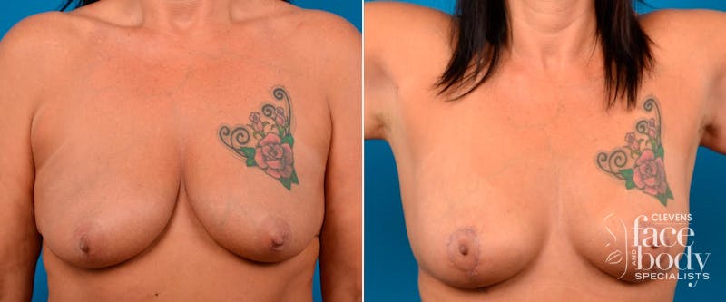 Hidden Breast Lift Before & After Gallery - Patient 111996 - Image 1