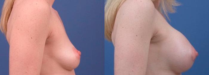 Hidden Breast Aug Before & After Gallery - Patient 404842 - Image 2