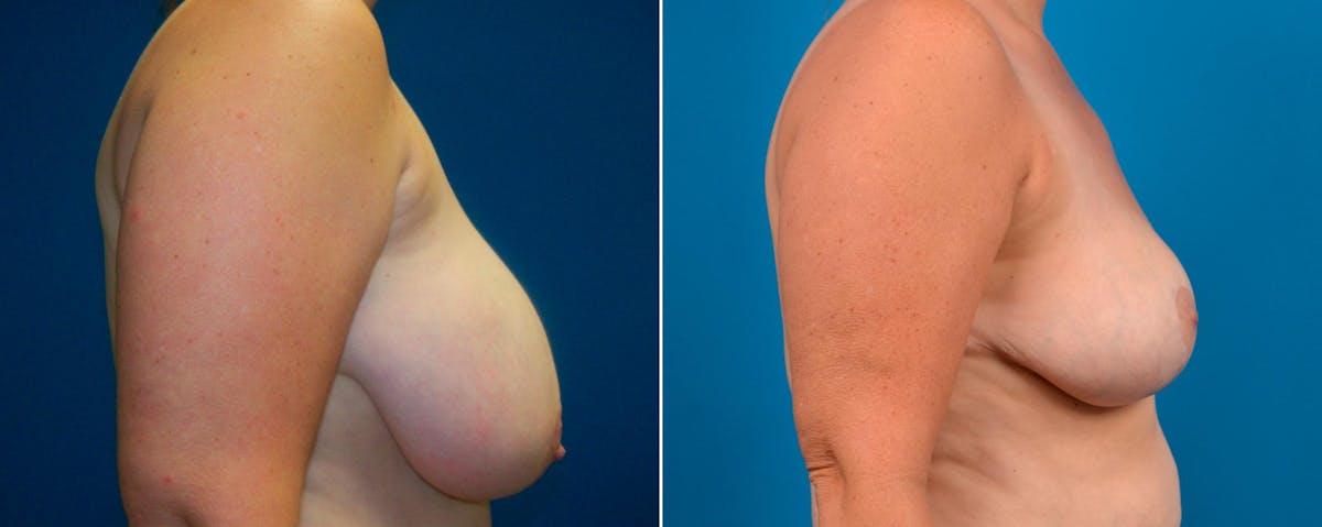 Breast Reduction Before & After Gallery - Patient 258926 - Image 2