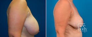 Hidden Breast Reduction Before & After Gallery - Patient 158033 - Image 2