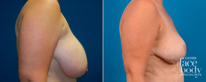 Hidden Breast Reduction Before & After Gallery - Patient 158033 - Image 2